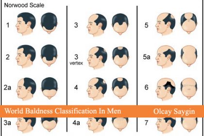 hair_replacement_therapy copy