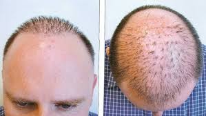 What might be the consequences of a wrong hairtransplant ?