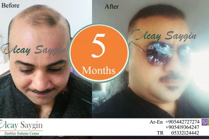 Dr Zen Hair Transplant Olcay Saygin