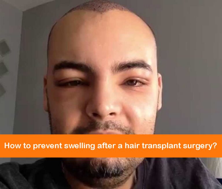 how-to-prevent-swelling-after-a-hair-transplant-surgery-zenhair-turkiye