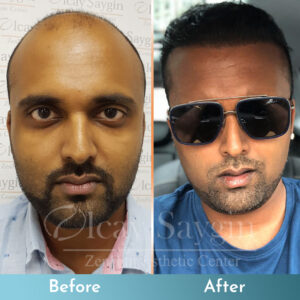 Olcay Saygin Hair Transplant 26
