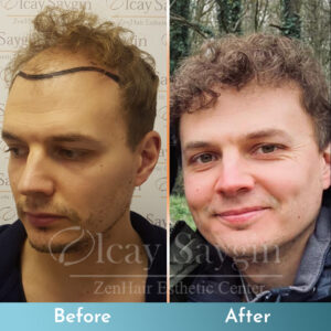 Olcay Saygin Hair Transplant 63