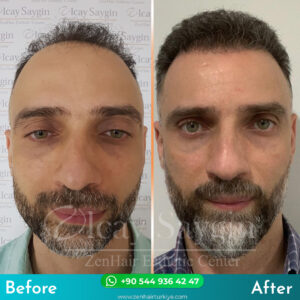 before after yeni