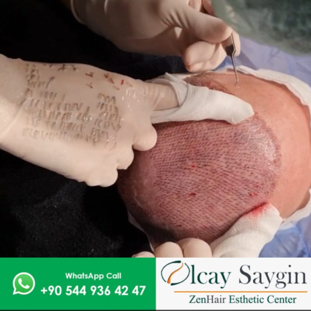 What Role Does a Graft Have in Hair Transplantation ?