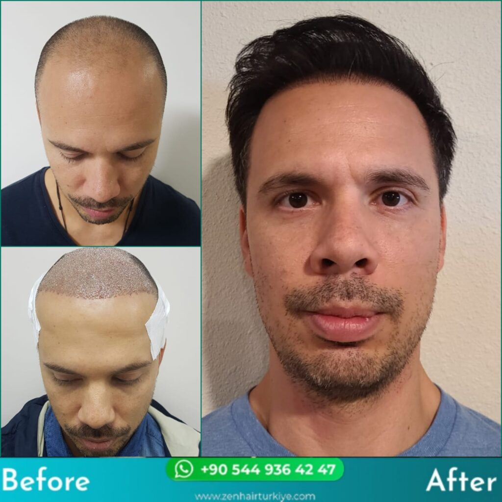 Failed Hair Transplant: Can You Avoid or Fix It?